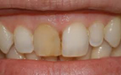 dente devitalizzato1