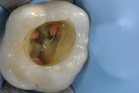 dente devitalizzato6