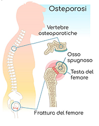 osteoporosi3 tn