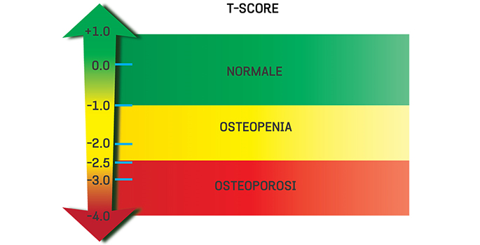 osteoporosi7