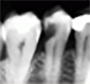 dente2