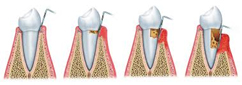 dente3