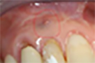 dente1