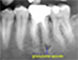 dente2