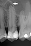 dente3