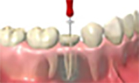 dente4